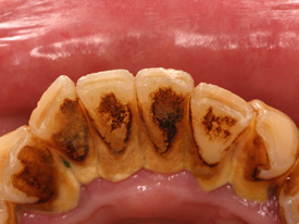 インプラントと歯周病２
